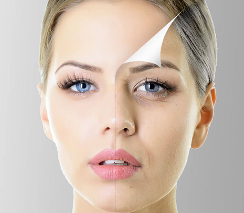 Chemical Peels Treatment in South Delhi