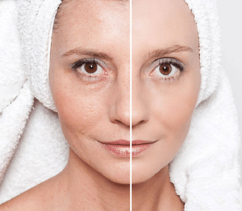 Chemical Peels Treatment in South Delhi